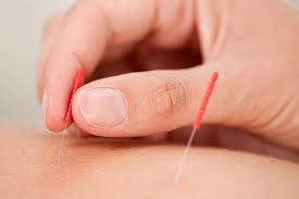 chinese acupuncture Melbourne
