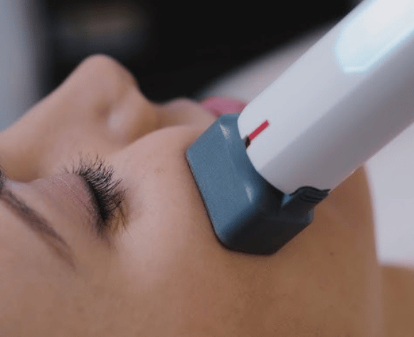 XERF structural skin tightening